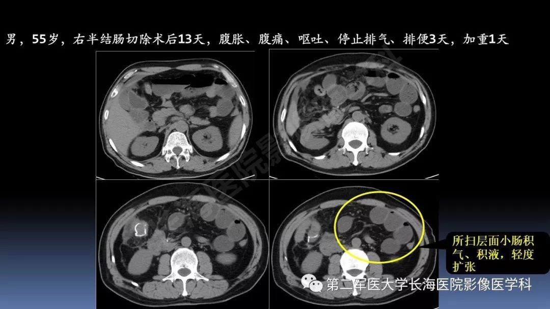 影像PPT - 【PPT】急腹症CT读片思路解析-26