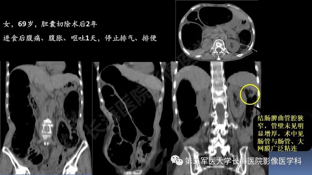 影像PPT - 【PPT】急腹症CT读片思路解析-27