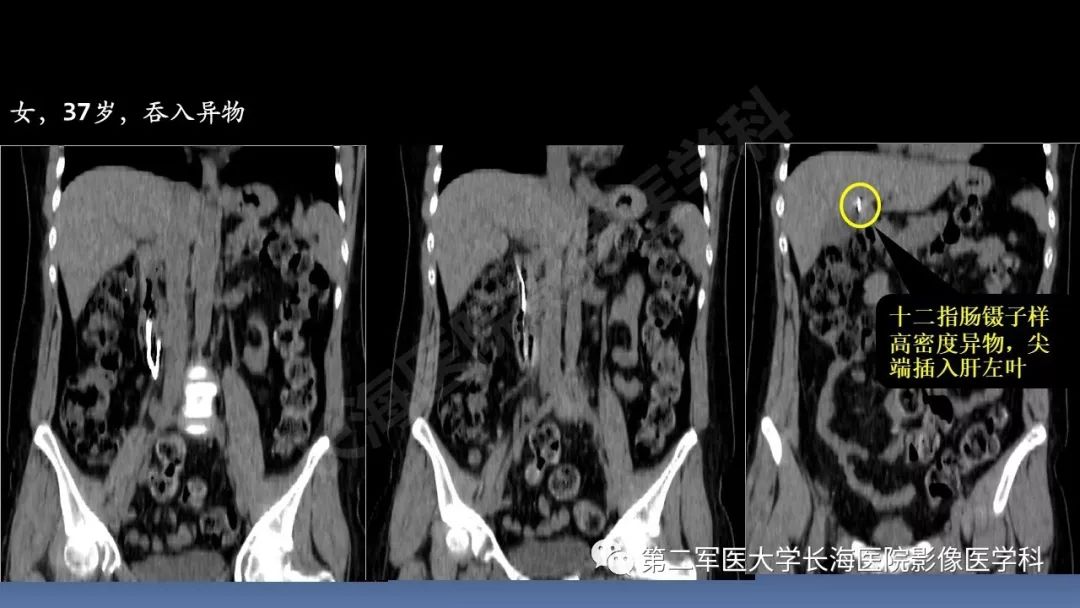 影像PPT - 【PPT】急腹症CT读片思路解析-31