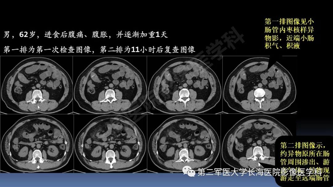 影像PPT - 【PPT】急腹症CT读片思路解析-32