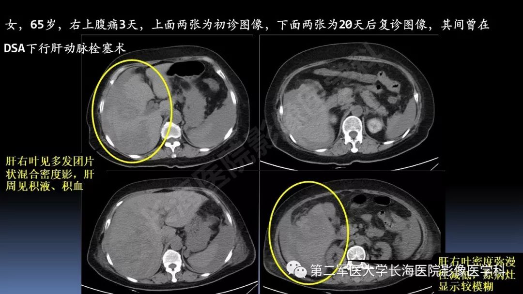 影像PPT - 【PPT】急腹症CT读片思路解析-34