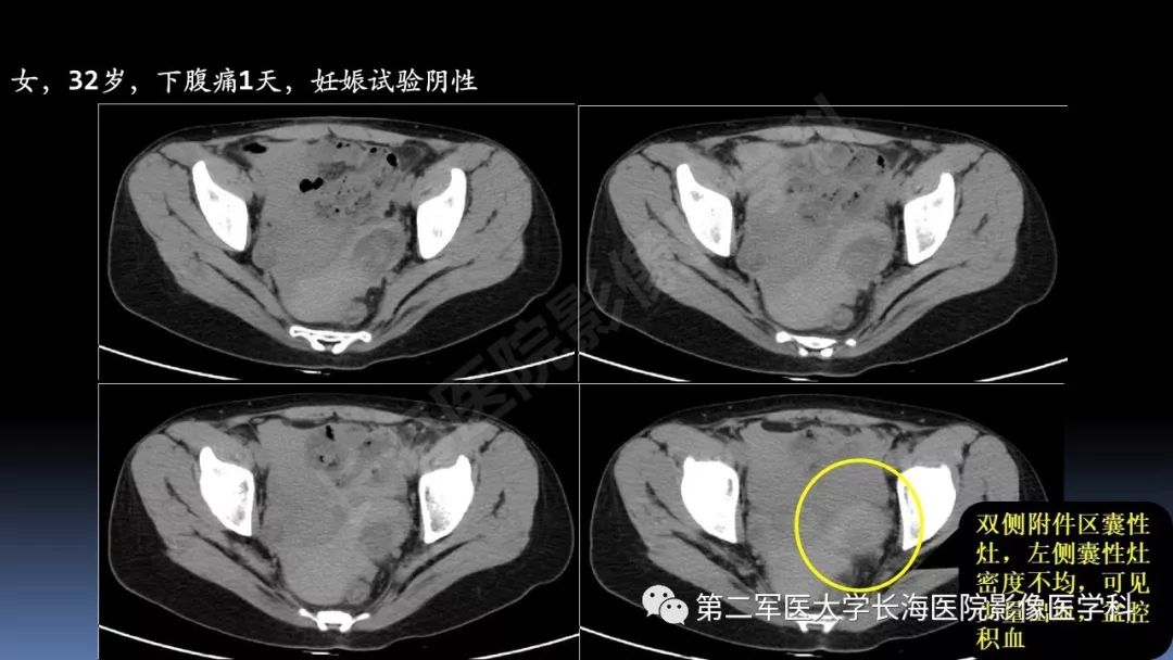 影像PPT - 【PPT】急腹症CT读片思路解析-37
