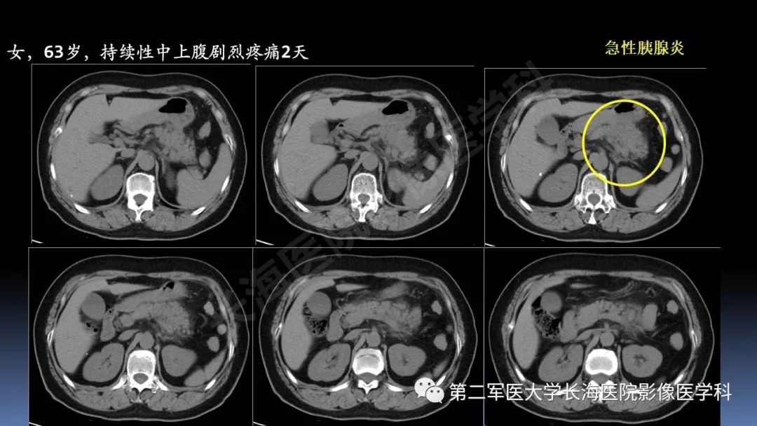 影像PPT - 【PPT】急腹症CT读片思路解析-44