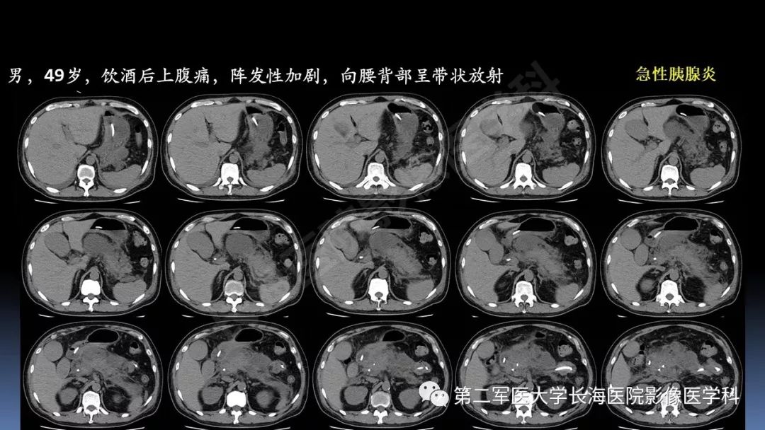 影像PPT - 【PPT】急腹症CT读片思路解析-45