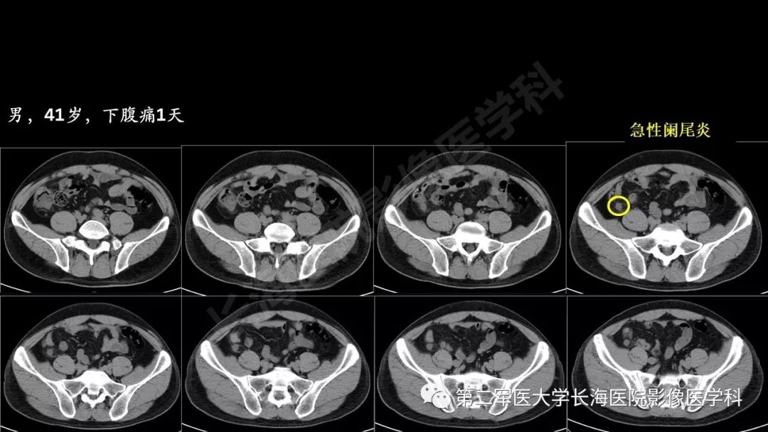 影像PPT - 【PPT】急腹症CT读片思路解析-46