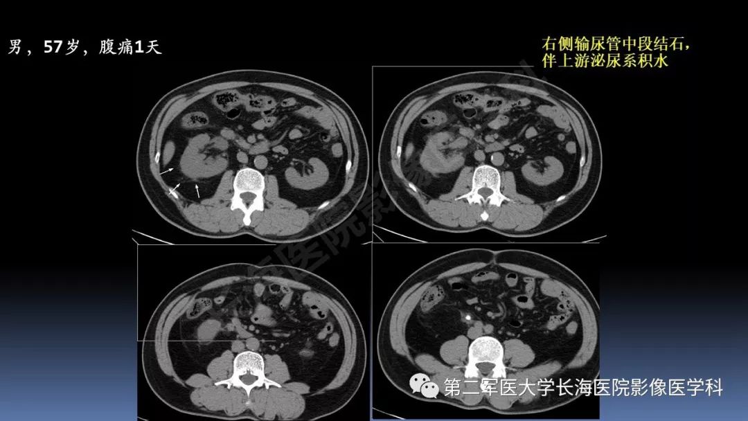 影像PPT - 【PPT】急腹症CT读片思路解析-47