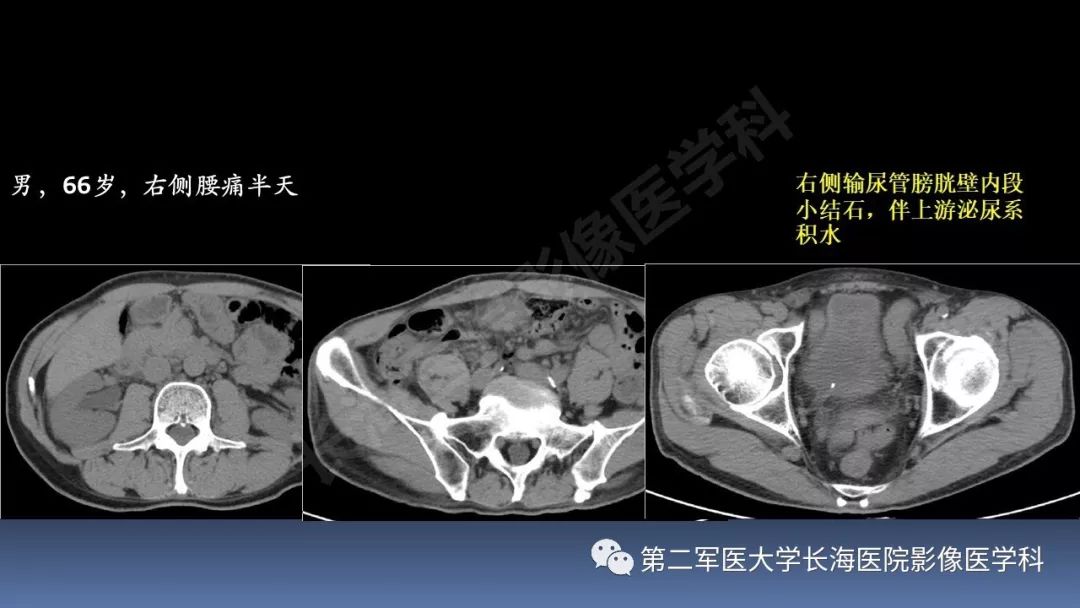 影像PPT - 【PPT】急腹症CT读片思路解析-48