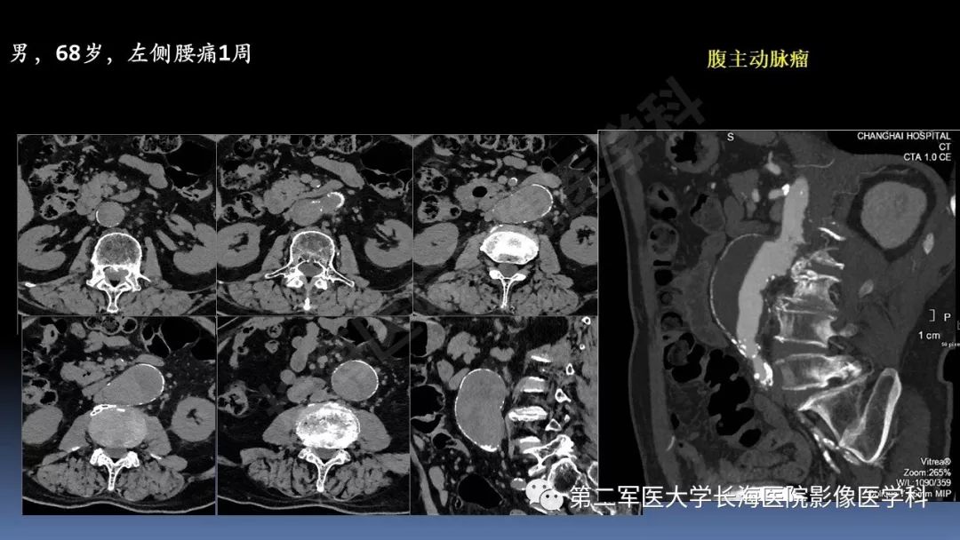 影像PPT - 【PPT】急腹症CT读片思路解析-49