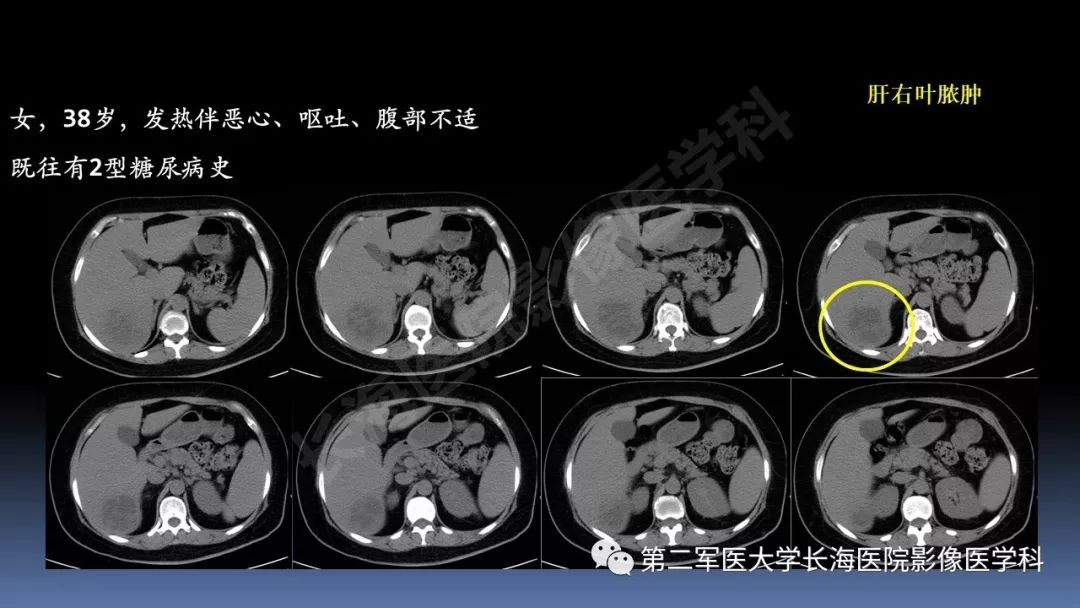 影像PPT - 【PPT】急腹症CT读片思路解析-51