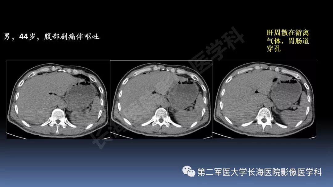 影像PPT - 【PPT】急腹症CT读片思路解析-52