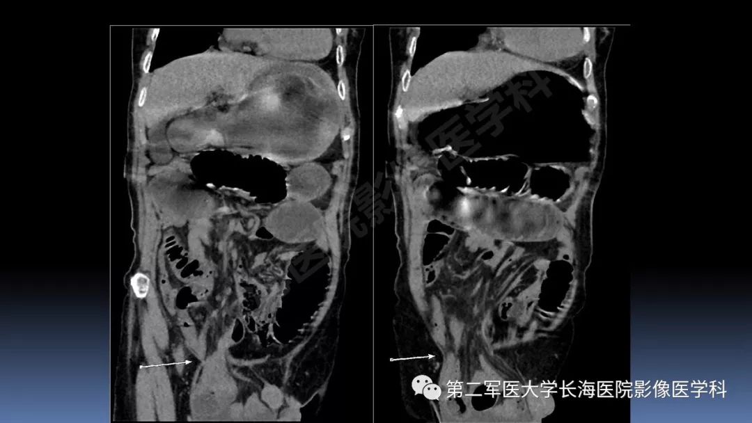 影像PPT - 【PPT】急腹症CT读片思路解析-54