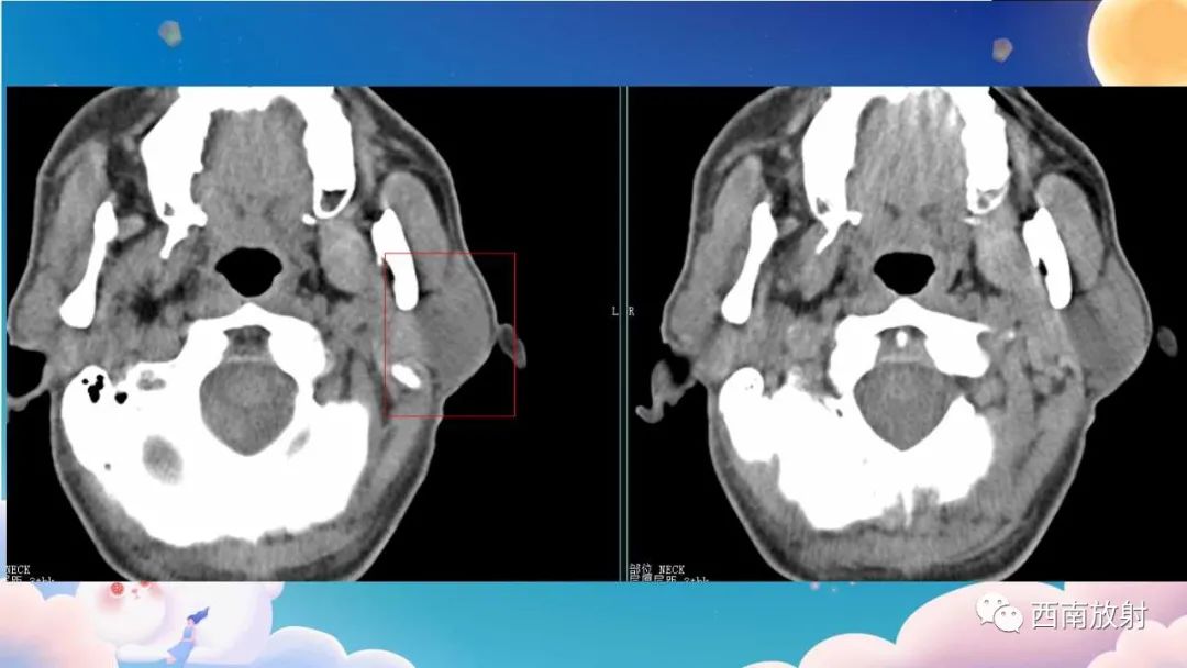 影像PPT - 【病例】腮腺腺淋巴瘤1例CT影像-2