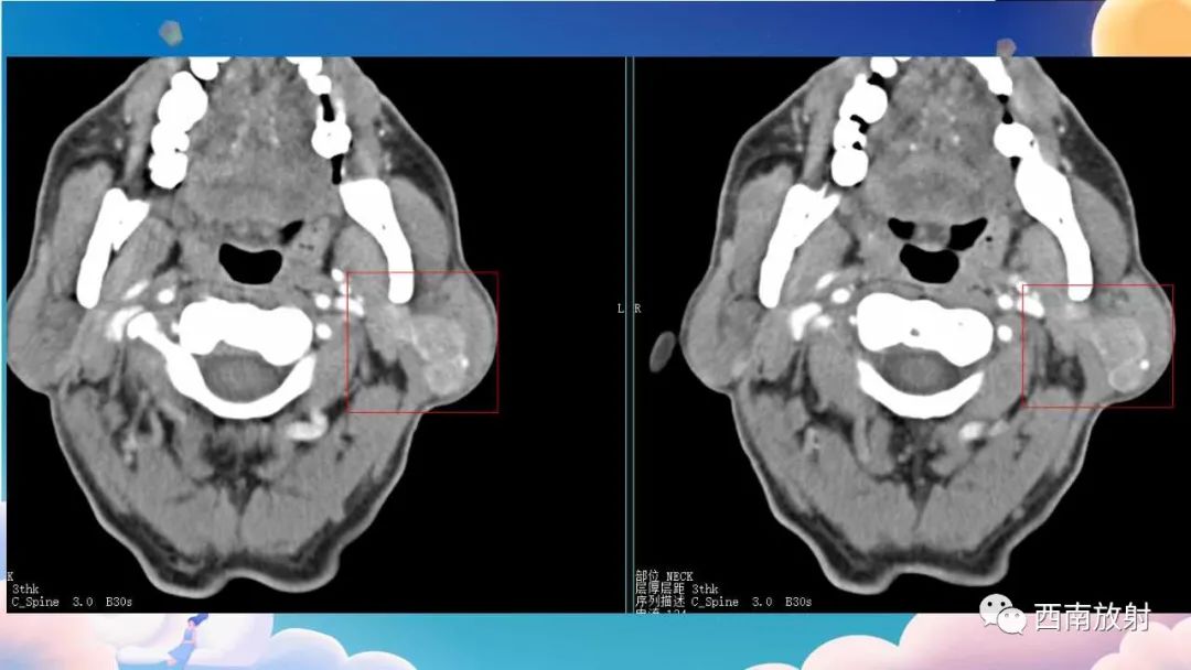 影像PPT - 【病例】腮腺腺淋巴瘤1例CT影像-3