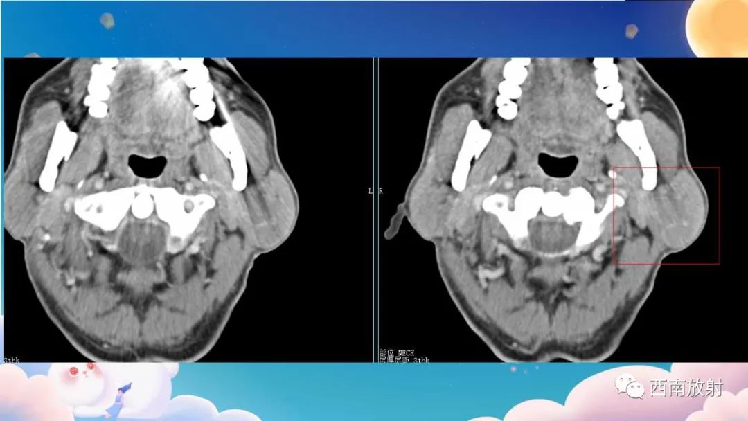 影像PPT - 【病例】腮腺腺淋巴瘤1例CT影像-4