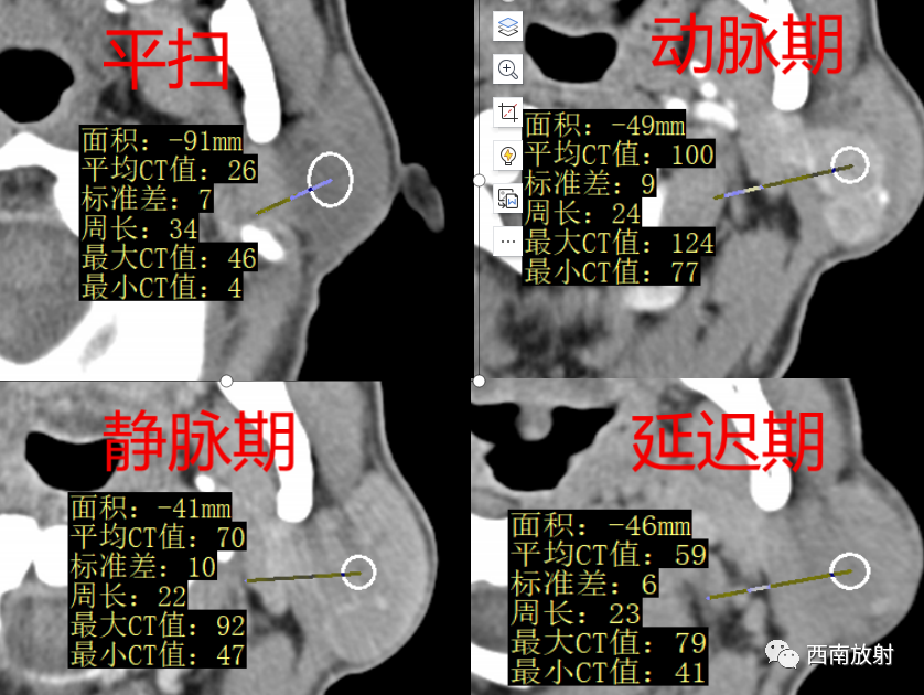 影像PPT - 【病例】腮腺腺淋巴瘤1例CT影像-8
