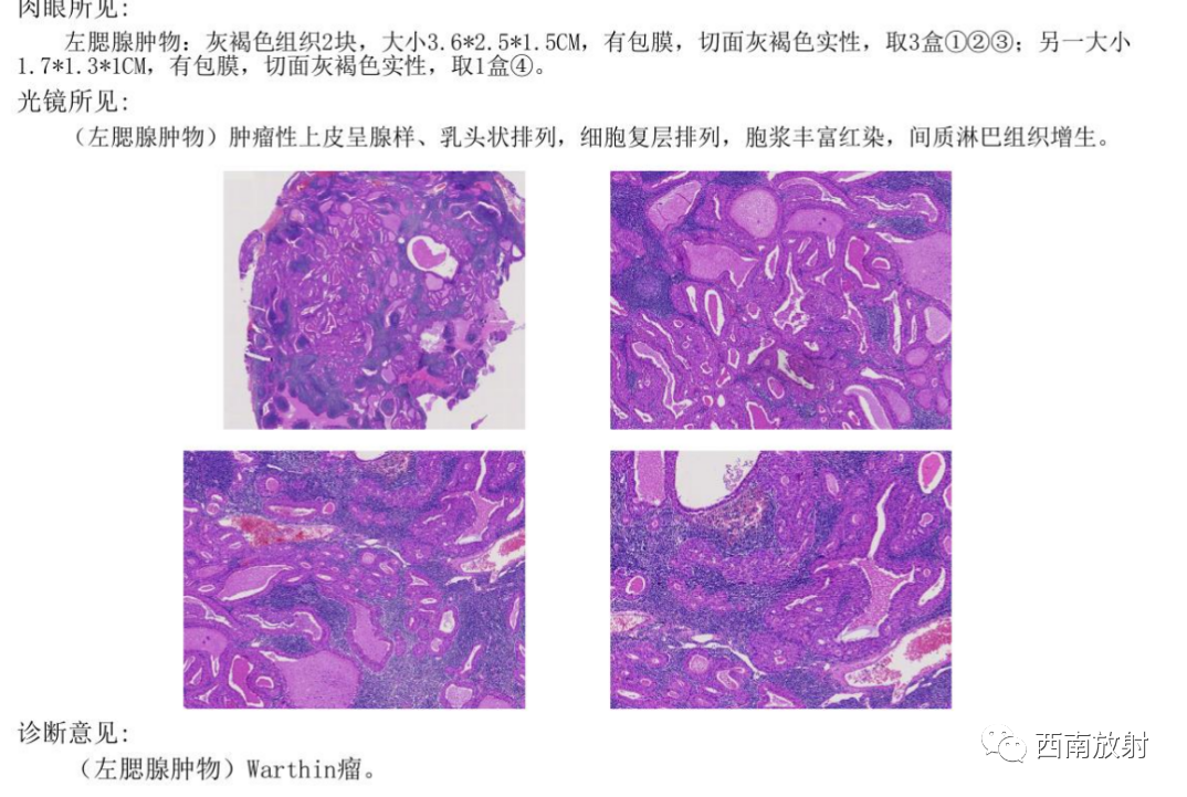 影像PPT - 【病例】腮腺腺淋巴瘤1例CT影像-11