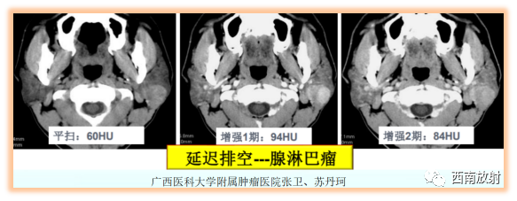 影像PPT - 【病例】腮腺腺淋巴瘤1例CT影像-13