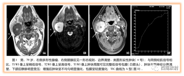 影像PPT - 【病例】腮腺腺淋巴瘤1例CT影像-16