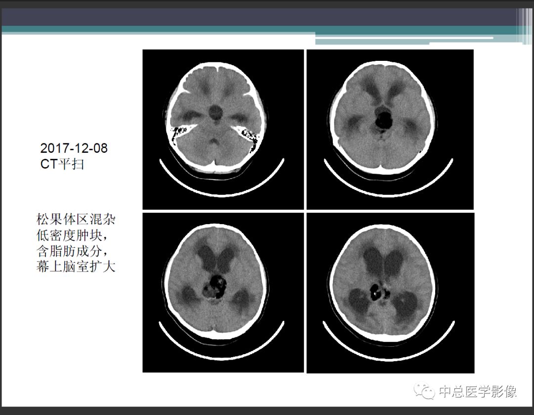 影像PPT - 【PPT】颅内生殖细胞瘤影像诊断-3