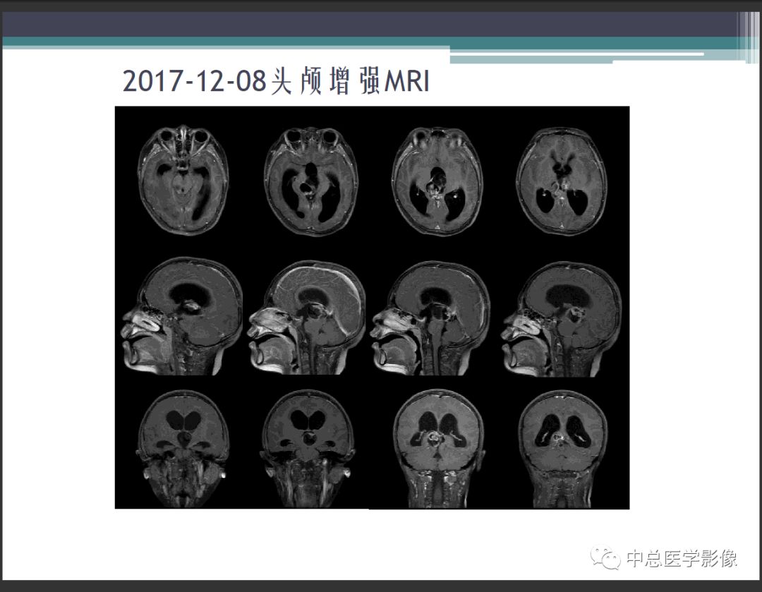影像PPT - 【PPT】颅内生殖细胞瘤影像诊断-4