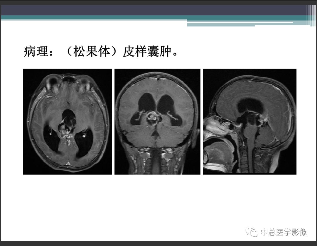 影像PPT - 【PPT】颅内生殖细胞瘤影像诊断-5