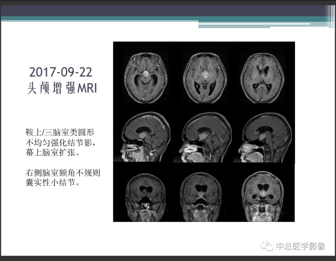 影像PPT - 【PPT】颅内生殖细胞瘤影像诊断-7