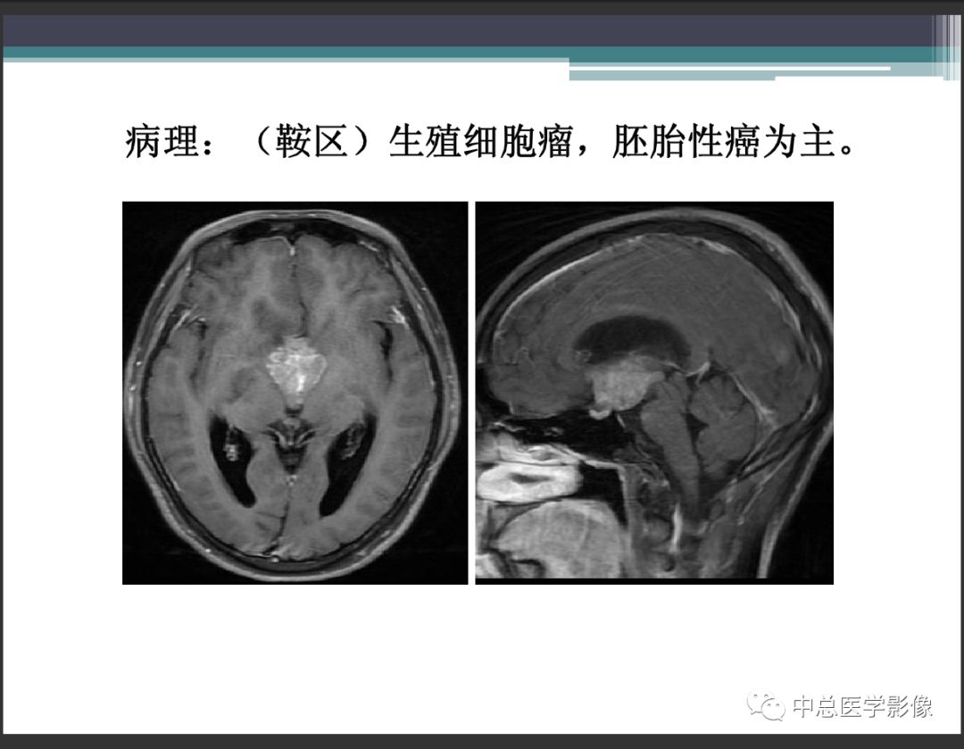 影像PPT - 【PPT】颅内生殖细胞瘤影像诊断-8