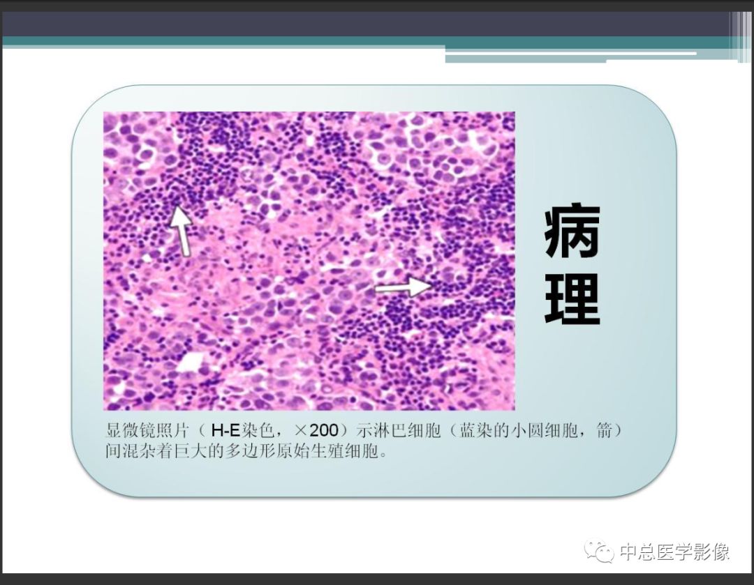 影像PPT - 【PPT】颅内生殖细胞瘤影像诊断-12