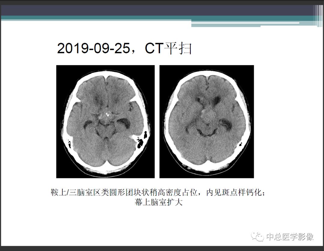 影像PPT - 【PPT】颅内生殖细胞瘤影像诊断-9