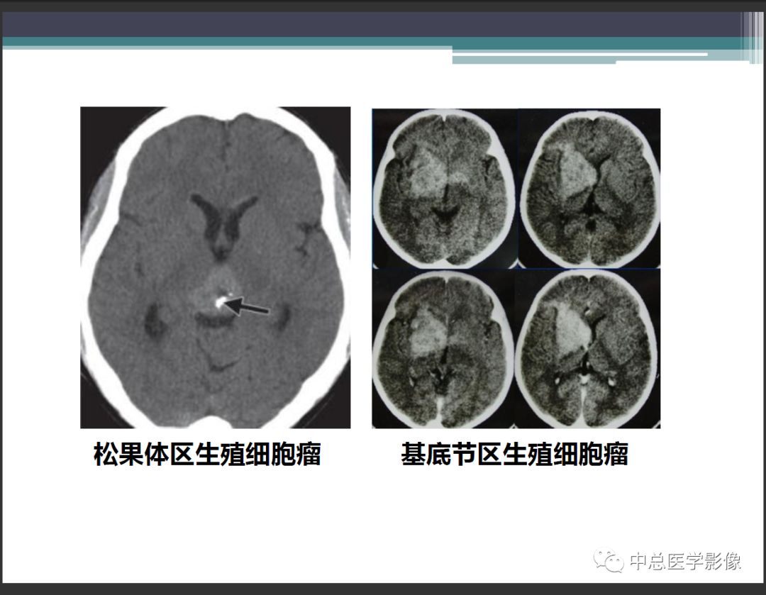 影像PPT - 【PPT】颅内生殖细胞瘤影像诊断-15