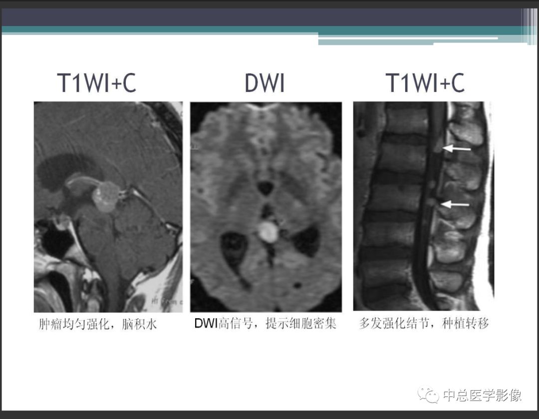影像PPT - 【PPT】颅内生殖细胞瘤影像诊断-16