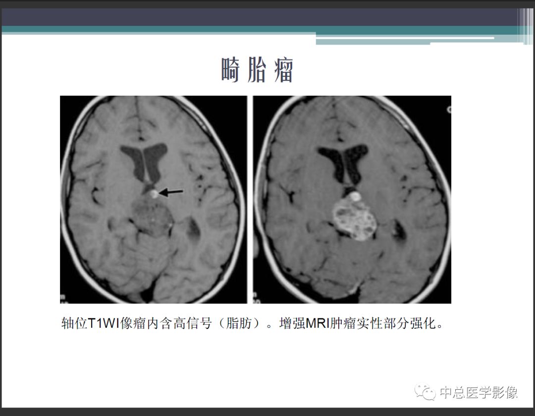 影像PPT - 【PPT】颅内生殖细胞瘤影像诊断-18