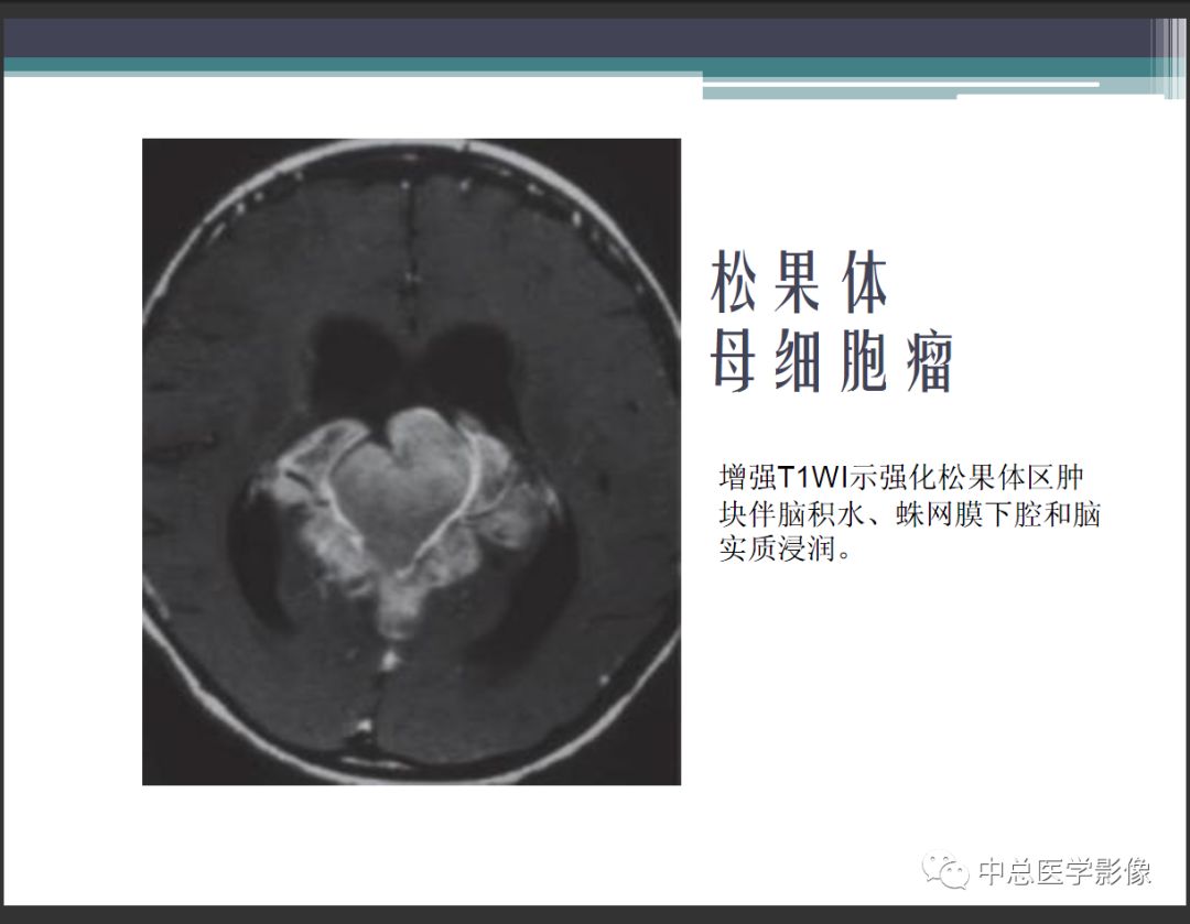 影像PPT - 【PPT】颅内生殖细胞瘤影像诊断-20