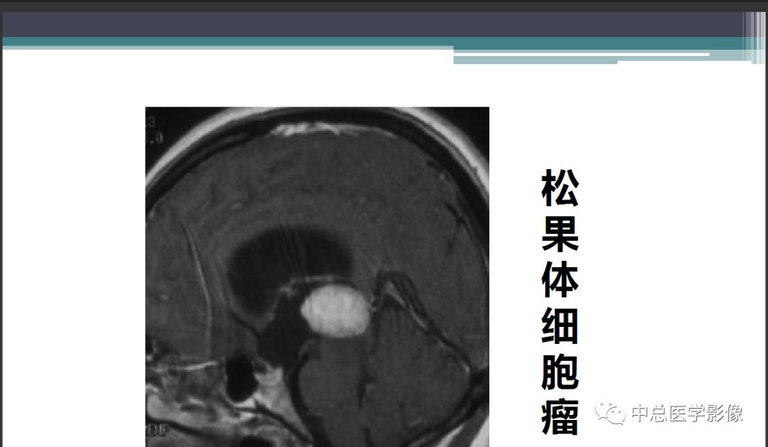 影像PPT - 【PPT】颅内生殖细胞瘤影像诊断-22