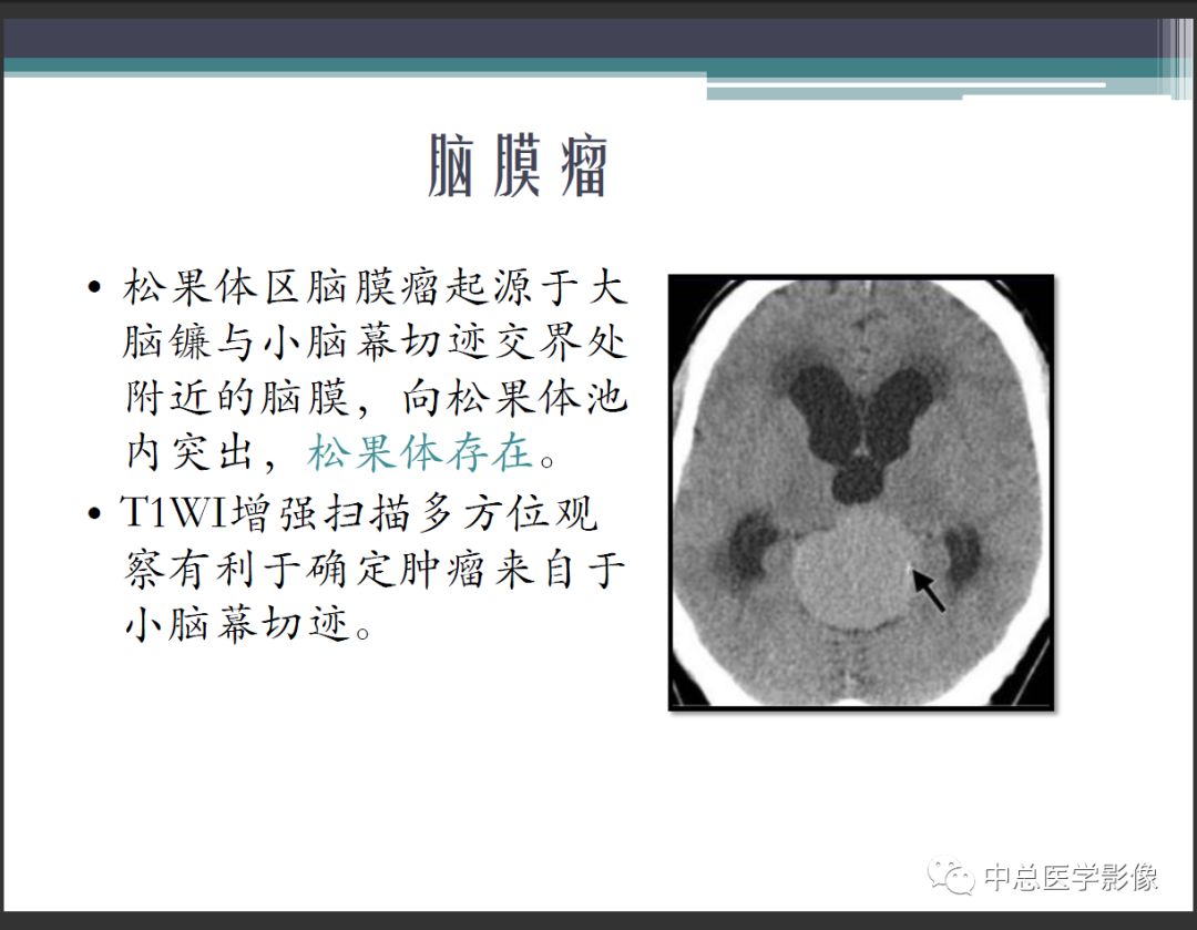 影像PPT - 【PPT】颅内生殖细胞瘤影像诊断-23