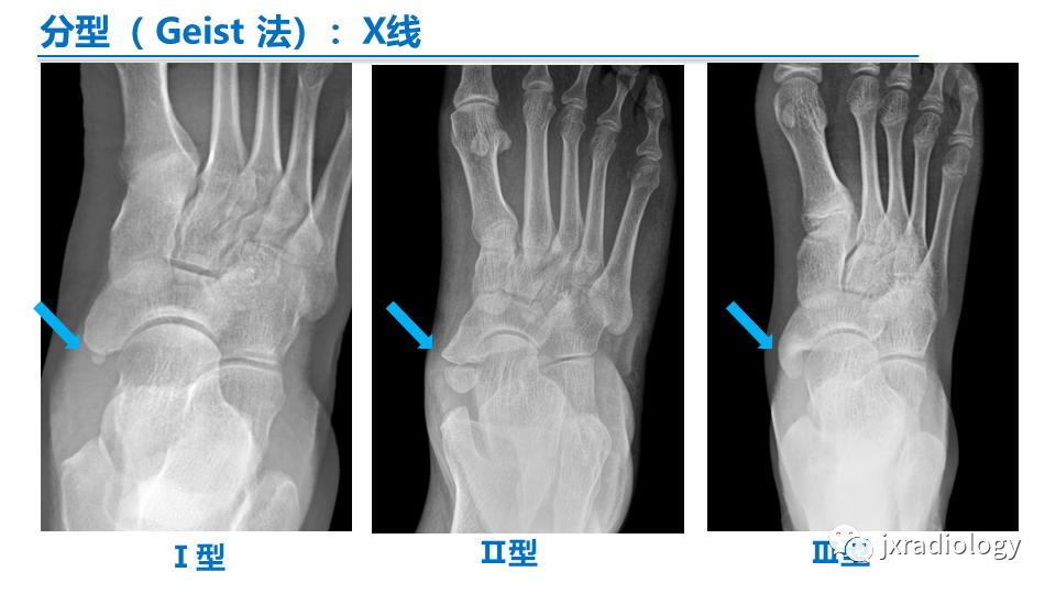影像PPT - 【PPT】足副舟骨分型及相关病变-8