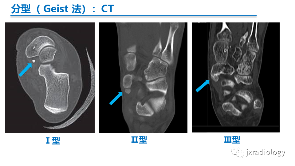 影像PPT - 【PPT】足副舟骨分型及相关病变-9