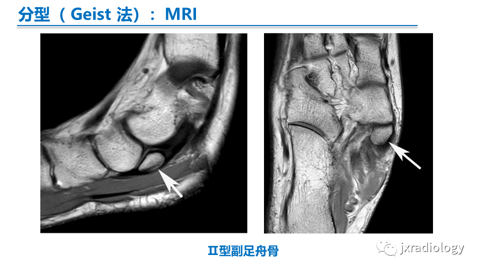 影像PPT - 【PPT】足副舟骨分型及相关病变-12