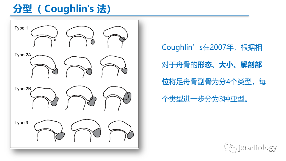 影像PPT - 【PPT】足副舟骨分型及相关病变-14