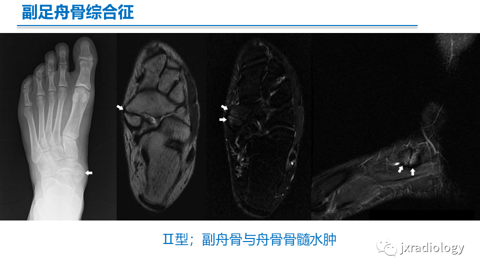 影像PPT - 【PPT】足副舟骨分型及相关病变-17