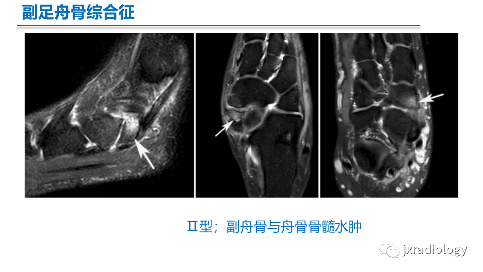 影像PPT - 【PPT】足副舟骨分型及相关病变-18