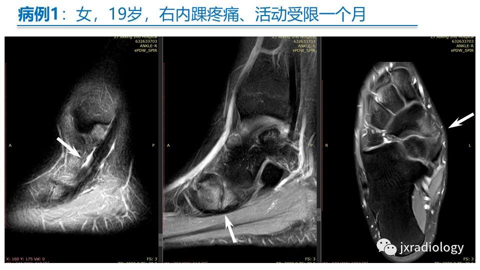 影像PPT - 【PPT】足副舟骨分型及相关病变-20