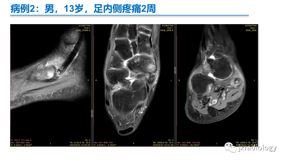 影像PPT - 【PPT】足副舟骨分型及相关病变-21