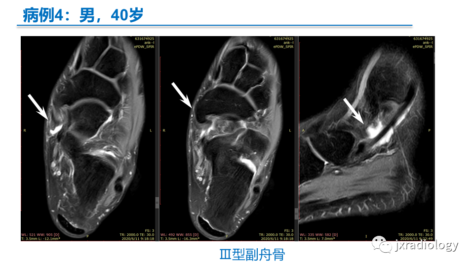 影像PPT - 【PPT】足副舟骨分型及相关病变-23