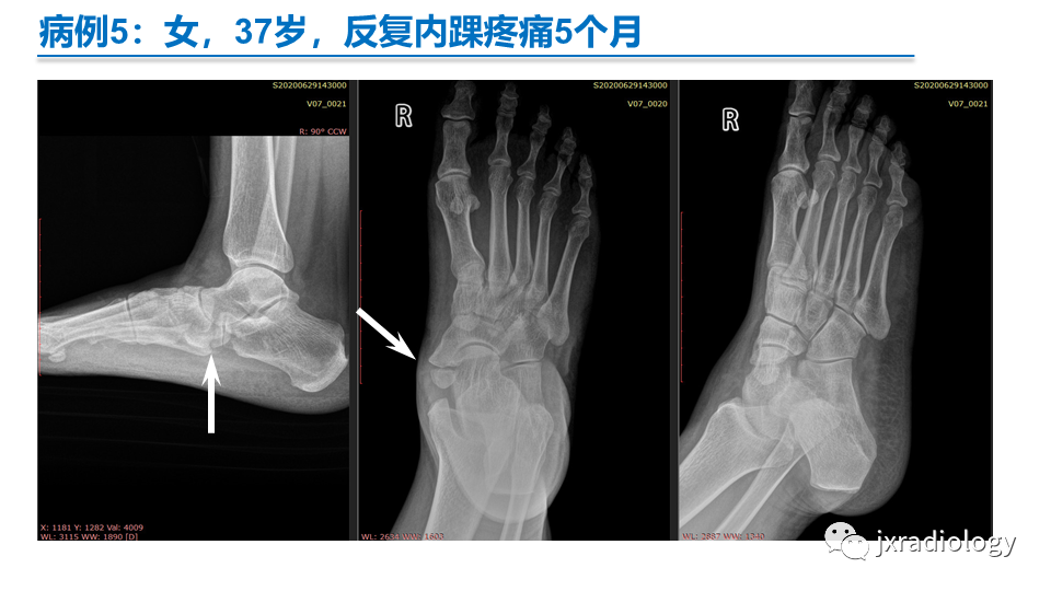 影像PPT - 【PPT】足副舟骨分型及相关病变-24