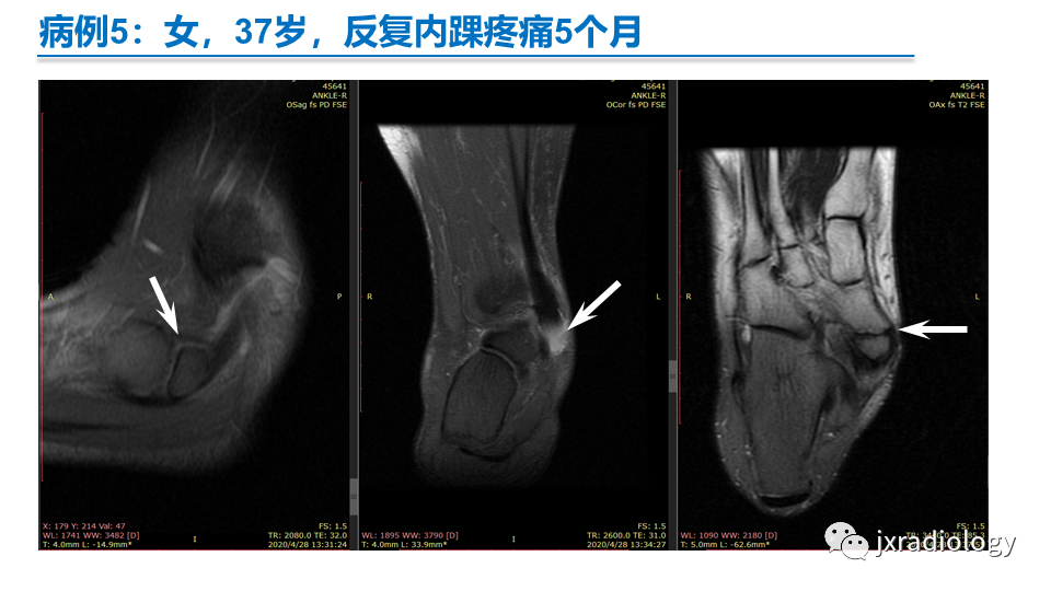 影像PPT - 【PPT】足副舟骨分型及相关病变-25