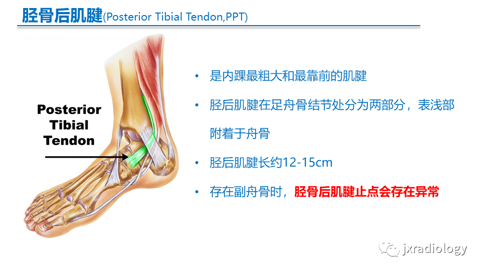 影像PPT - 【PPT】足副舟骨分型及相关病变-28