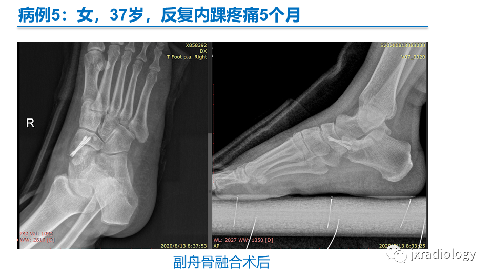影像PPT - 【PPT】足副舟骨分型及相关病变-26