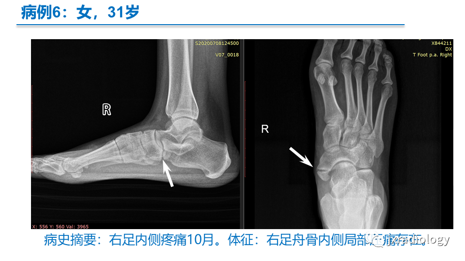 影像PPT - 【PPT】足副舟骨分型及相关病变-29