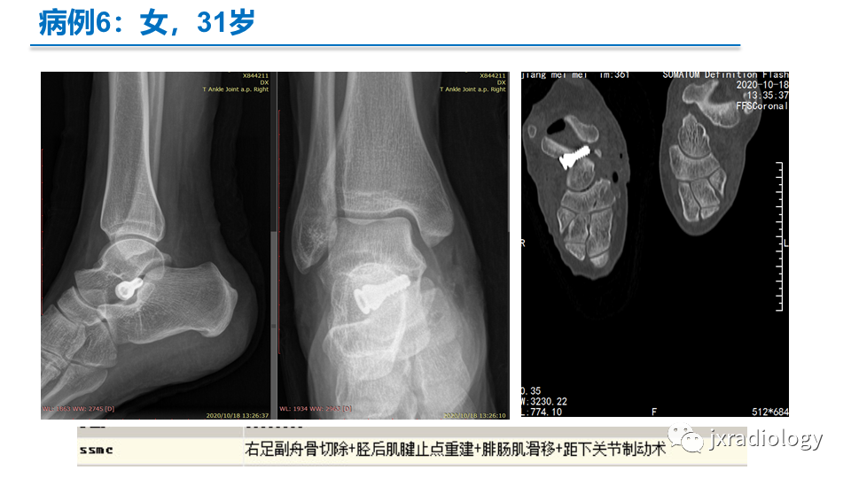 影像PPT - 【PPT】足副舟骨分型及相关病变-31